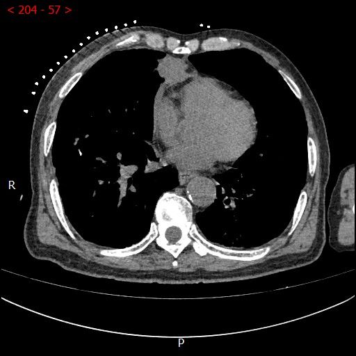 不开刀杀肿瘤：血管介入科开展首例CT引导下肺恶性肿瘤射频消融术