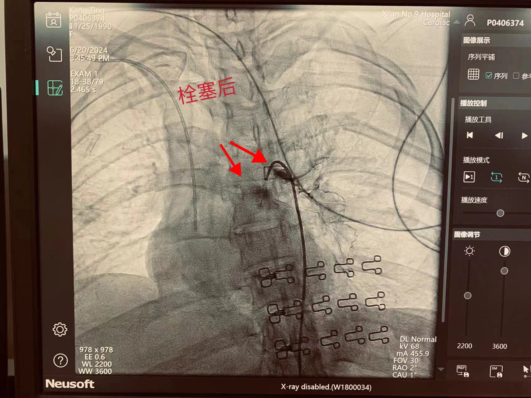时间就是生命,患者多发伤、失血性休克,介入急救止血“立竿见影” 时间就是生命,患者多发伤、失血性休克,介入急救止血“立竿见影”