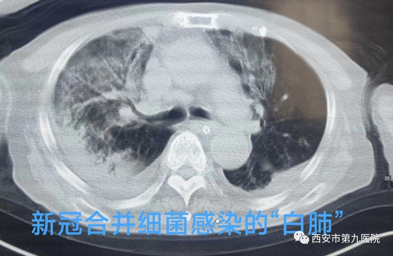 【科室动态】拯救“白肺”加“白脑”的八旬老人 【科室动态】拯救“白肺”加“白脑”的八旬老人