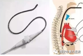 火眼金睛,一探究竟—经食道超声心动图 火眼金睛,一探究竟—经食道超声心动图