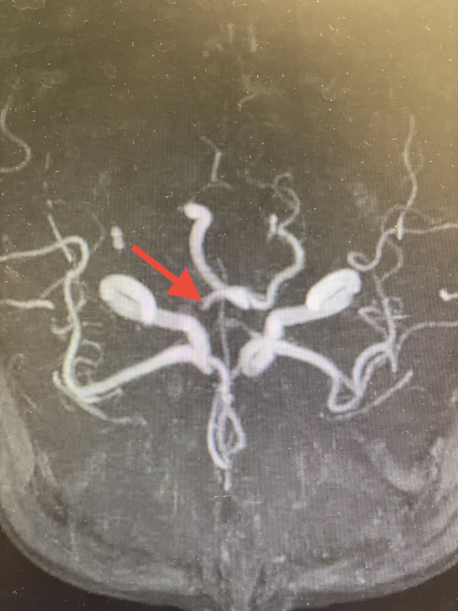 ADAPT技术快速开通颅内动脉栓塞一例 ADAPT技术快速开通颅内动脉栓塞一例