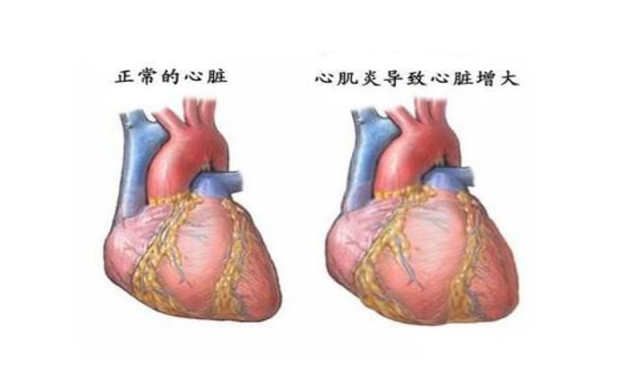 心肌炎患者应该注意什么？