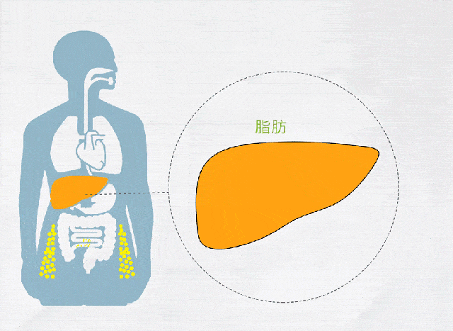 【健康科普】得了脂肪肝怎么办? 【健康科普】得了脂肪肝怎么办?