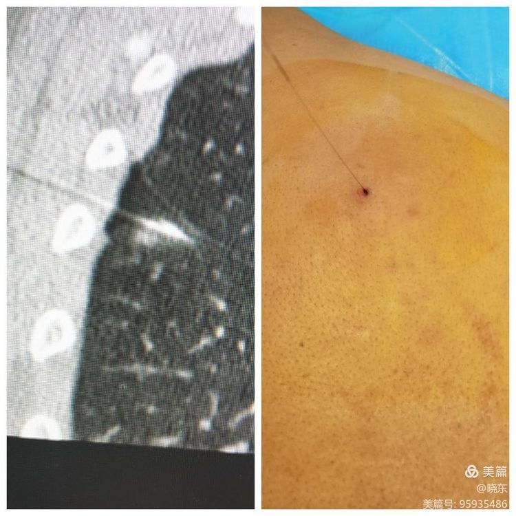 小结节不纠结,微创手术来解决 小结节不纠结,微创手术来解决