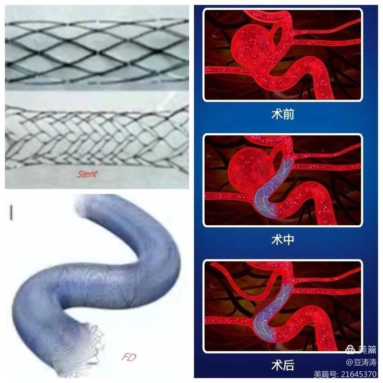 特色展示之九-血流导向装置在颅内复杂动脉瘤中的应用