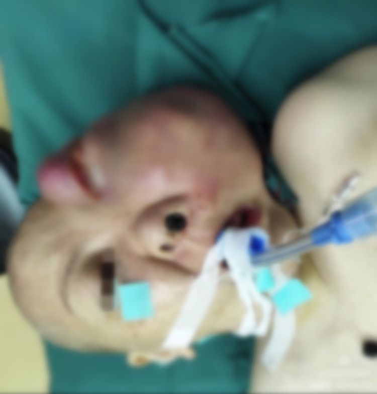 手术麻醉科“再战”困难气道