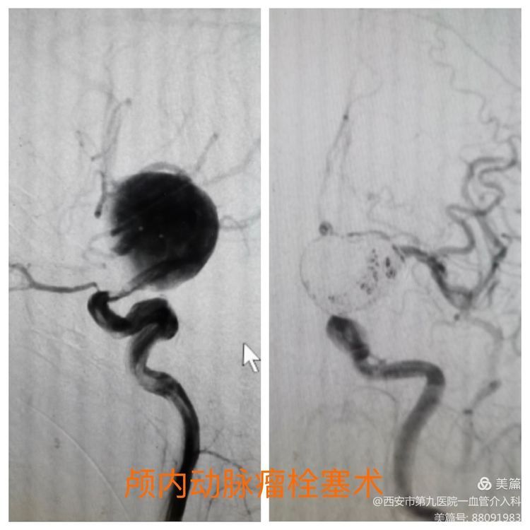 【血管介入科 】介入术中耗材保护的创新与临床应用