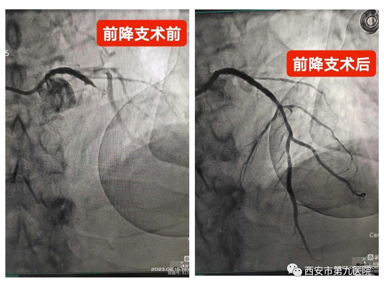 西安市第九医院120急救站与胸痛中心联合搭起“救心高速路” 西安市第九医院120急救站与胸痛中心联合搭起“救心高速路”