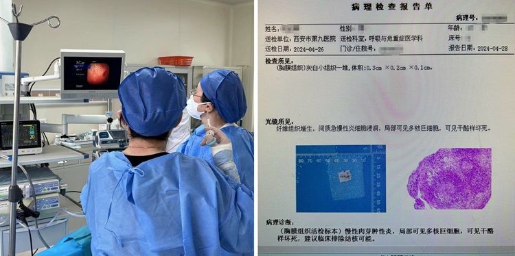 一探究“镜” 我院呼吸与危重症医学科成功开展首例内科胸腔镜检查 一探究“镜” 我院呼吸与危重症医学科成功开展首例内科胸腔镜检查