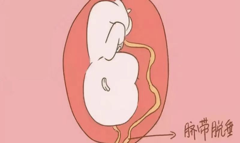 惊心动魄!产妇突发脐带脱垂,妇产科团队上演急速救援 惊心动魄!产妇突发脐带脱垂,妇产科团队上演急速救援