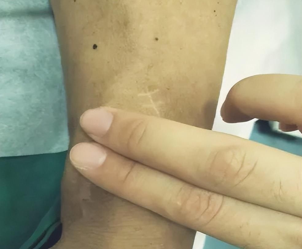 透析患者如何进行内瘘的日常维护? 透析患者如何进行内瘘的日常维护?
