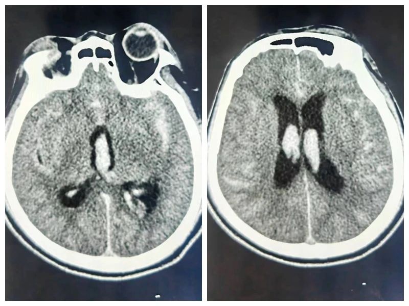 【典型病例】摔倒了可不一定就是外伤,小心“炸弹”来袭 【典型病例】摔倒了可不一定就是外伤,小心“炸弹”来袭