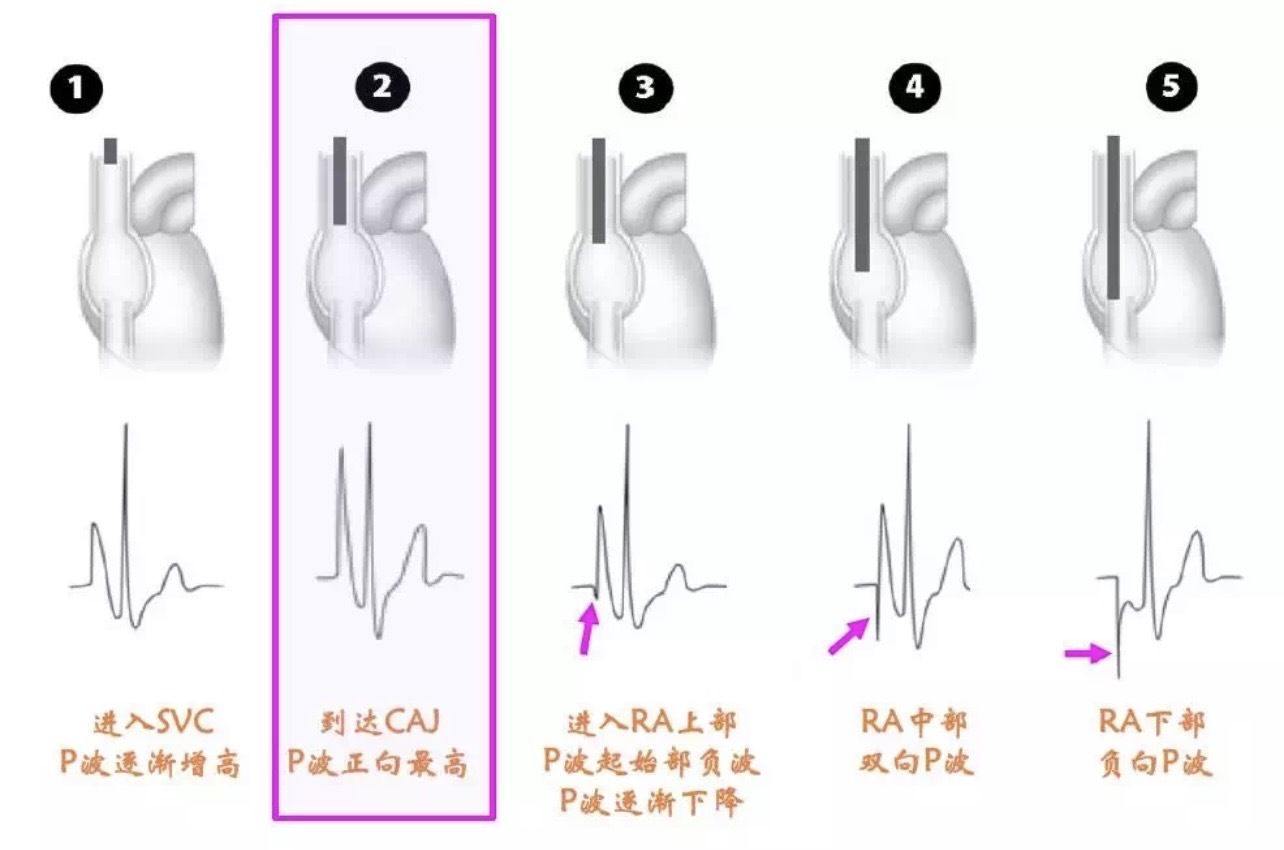 精准定位,精心守护——我院神经外科成功开展PICC腔内心电定位新技术 精准定位,精心守护——我院神经外科成功开展PICC腔内心电定位新技术