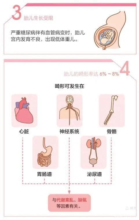 妊娠合并糖尿病对孕妇和宝宝的危害