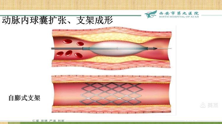 【特色技术】神经外科——球囊扩张及支架成形术治疗颅内动脉粥样硬化性狭窄（ICAS）