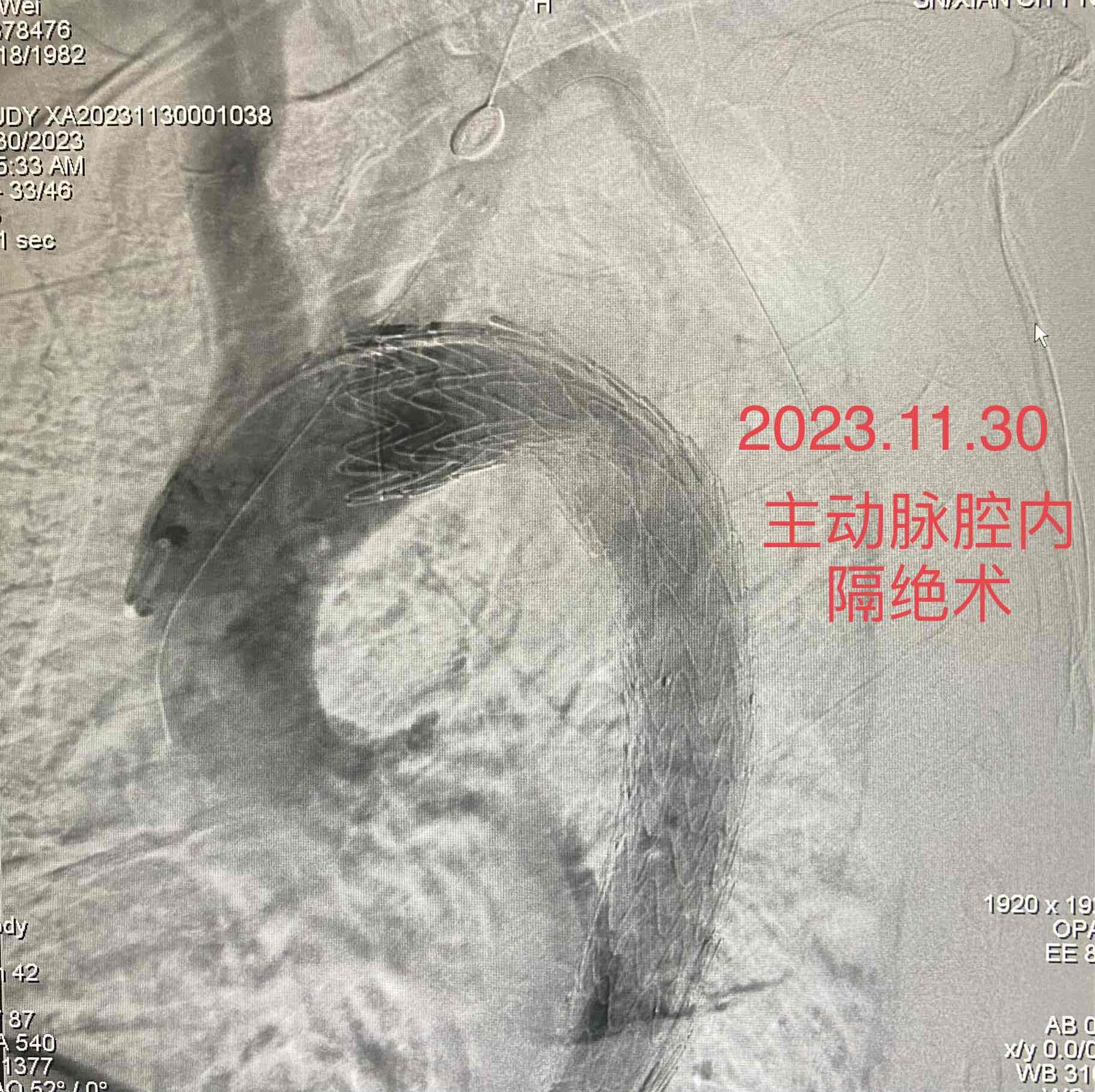 一例急性主动脉夹层患者就诊记