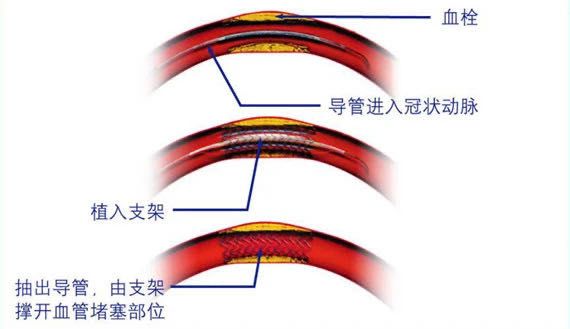 【健康知识】心血管内科袁博医师:浅谈心脏支架 【健康知识】心血管内科袁博医师:浅谈心脏支架
