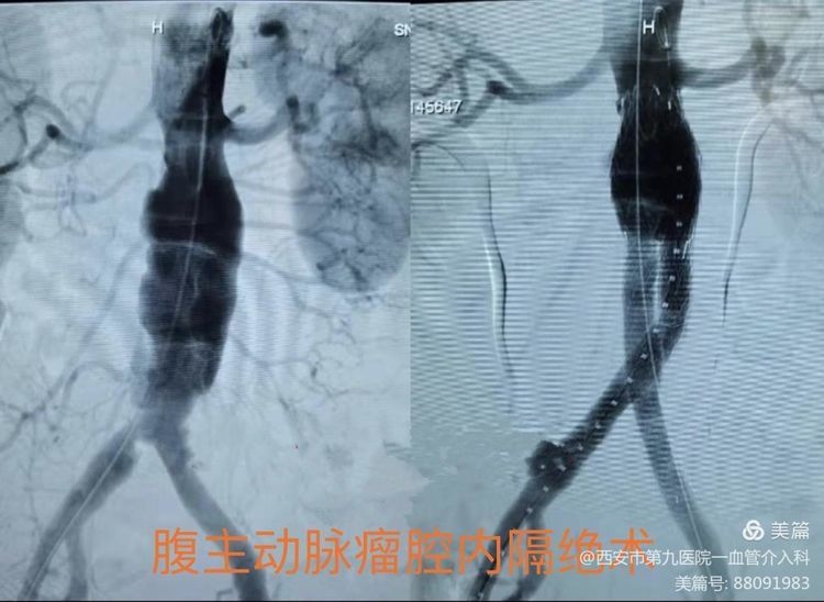 【血管介入科 】介入术中耗材保护的创新与临床应用