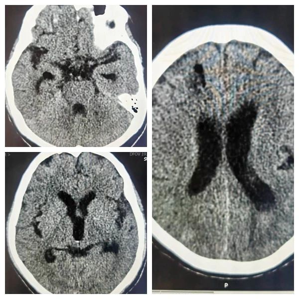 【典型病例】摔倒了可不一定就是外伤,小心“炸弹”来袭 【典型病例】摔倒了可不一定就是外伤,小心“炸弹”来袭
