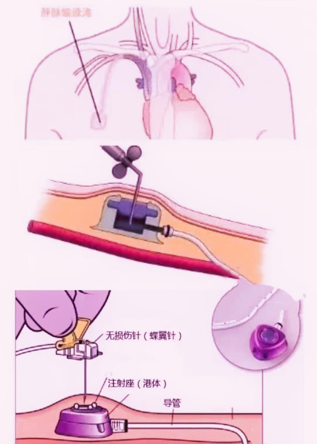 【科普知识】如何正确使用输液港 【科普知识】如何正确使用输液港