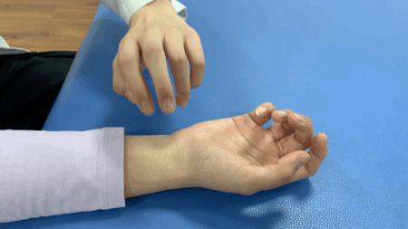 【健康科普】腕管综合征的康复治疗 【健康科普】腕管综合征的康复治疗