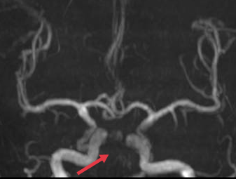 【医疗技术】神内卒中团队开通基底动脉1例 【医疗技术】神内卒中团队开通基底动脉1例