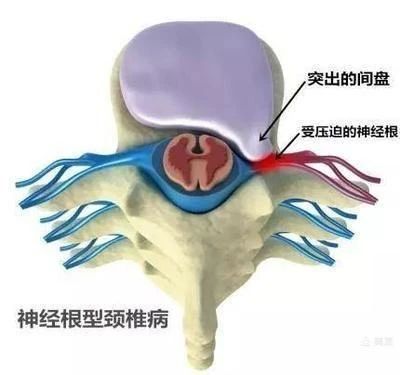 【科普园地】颈椎病篇二:认识颈椎病 【科普园地】颈椎病篇二:认识颈椎病