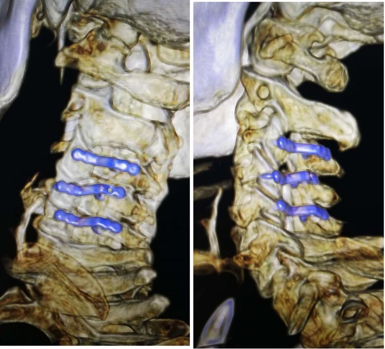 骨科救治一例颈髓损伤患者