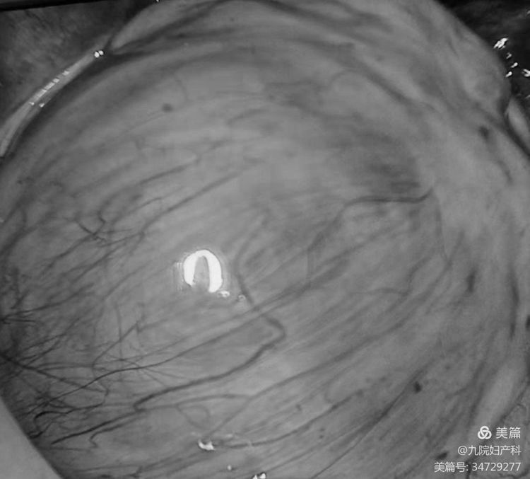 阴式手术—无痕剥除卵巢肿瘤