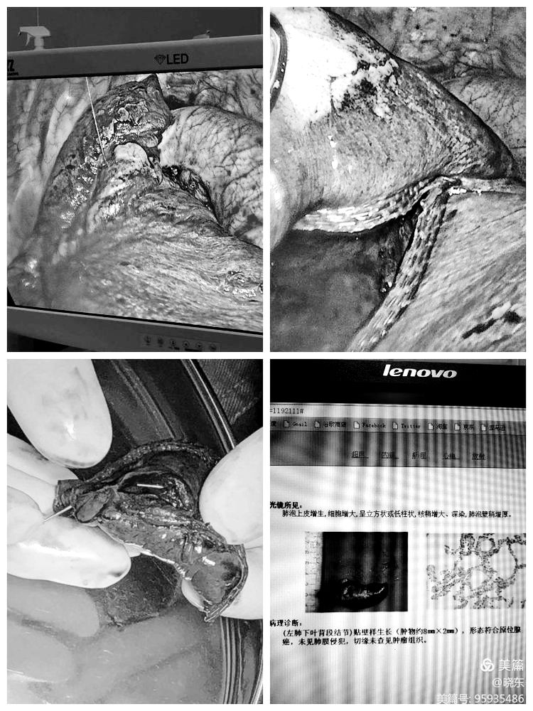 小结节不纠结,微创手术来解决 小结节不纠结,微创手术来解决