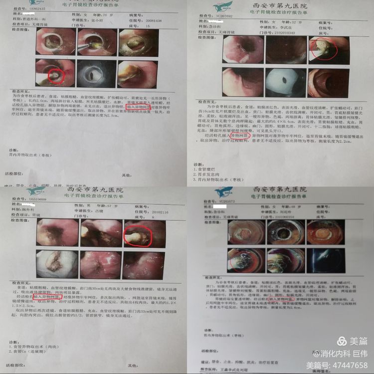 网篮在异物取出术中的应用
