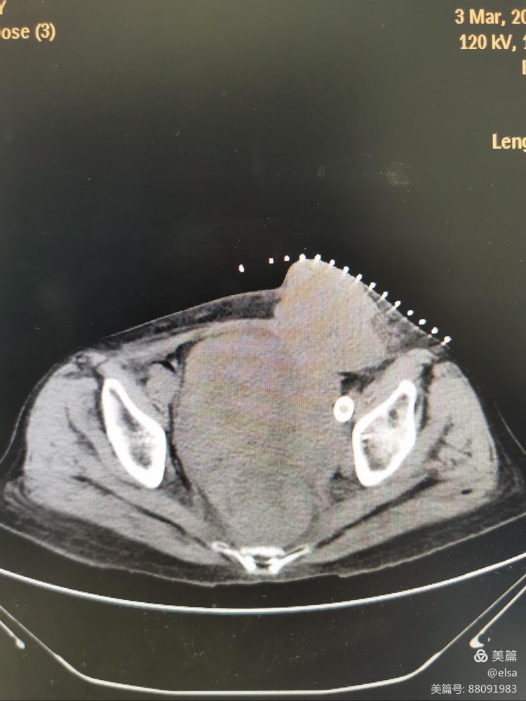 【仁医新术】血管介入科成功开展首例腹腔恶性肿瘤微波消融术