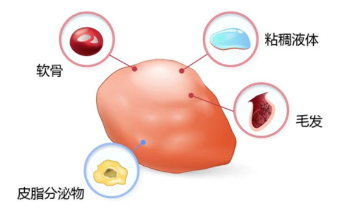 我院妇产科团队成功救治年仅13岁畸胎瘤患者 我院妇产科团队成功救治年仅13岁畸胎瘤患者