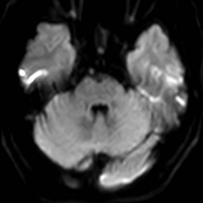 【医疗技术】神内卒中团队开通基底动脉1例 【医疗技术】神内卒中团队开通基底动脉1例