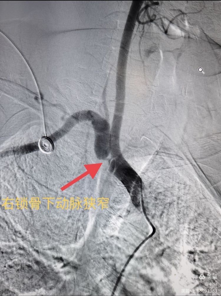 锁骨下动脉盗血症