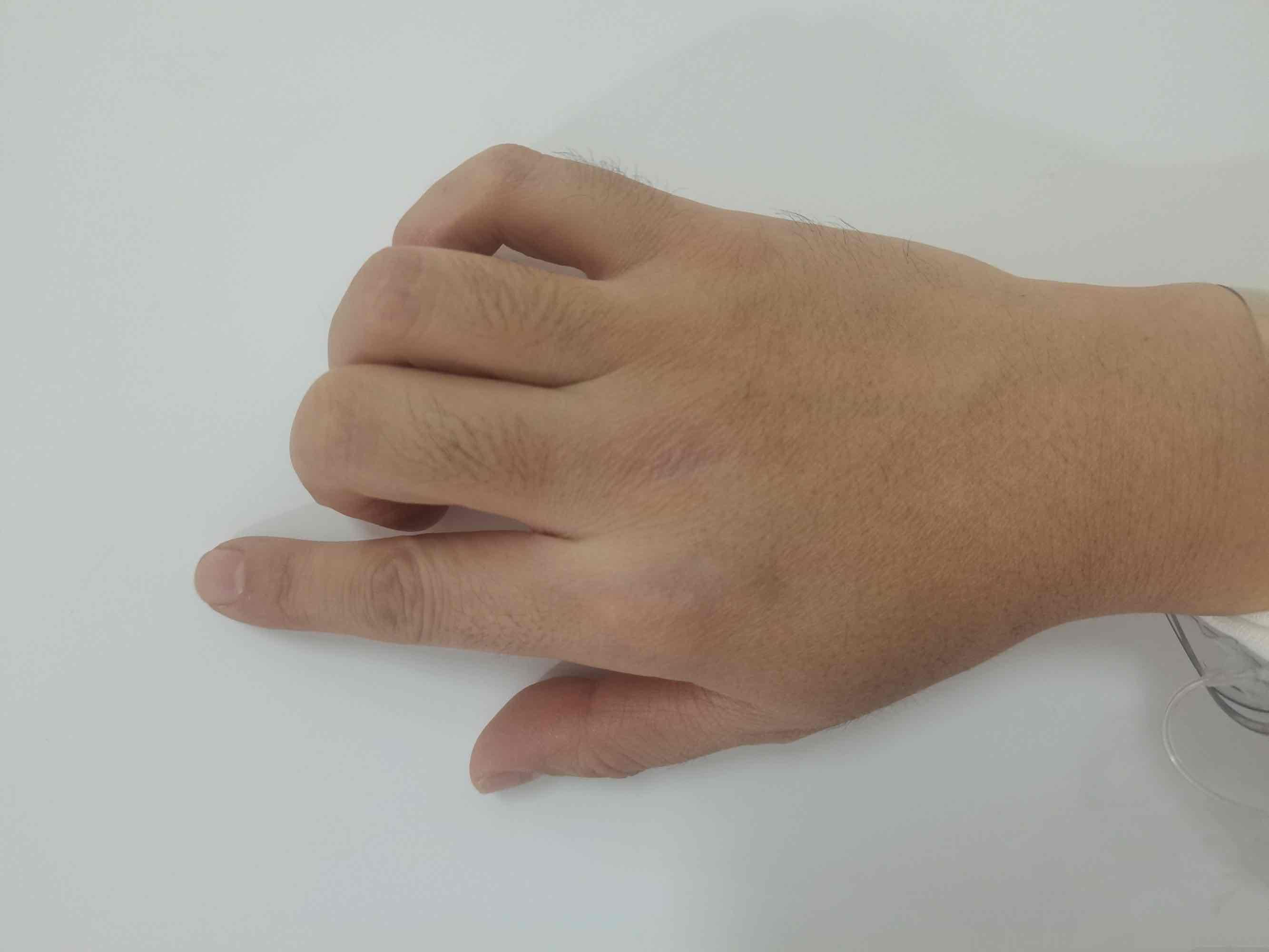 小小手指操，解决介入术后患者大问题