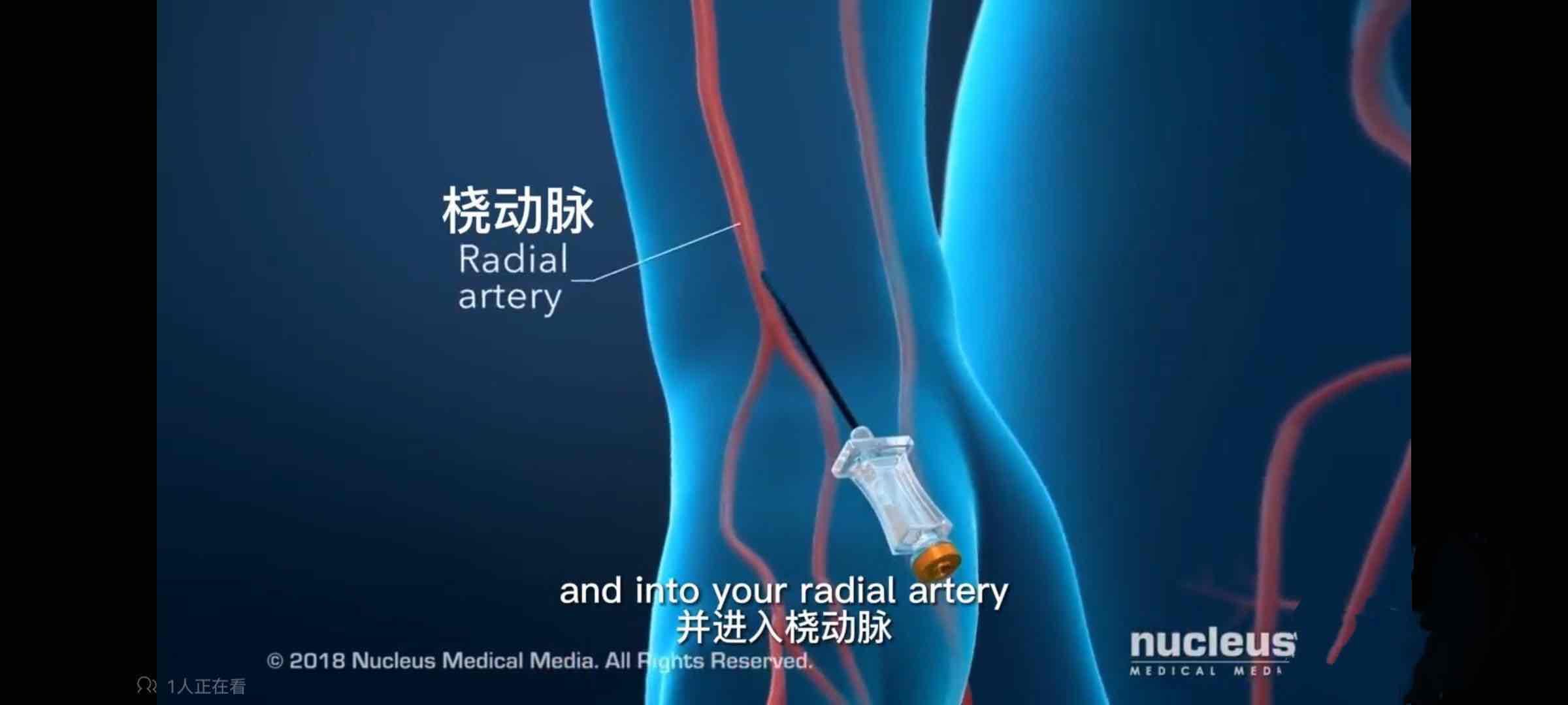 小小手指操，解决介入术后患者大问题