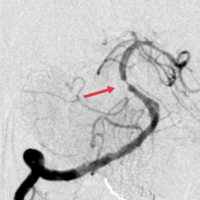 【医疗技术】神内卒中团队开通基底动脉1例 【医疗技术】神内卒中团队开通基底动脉1例