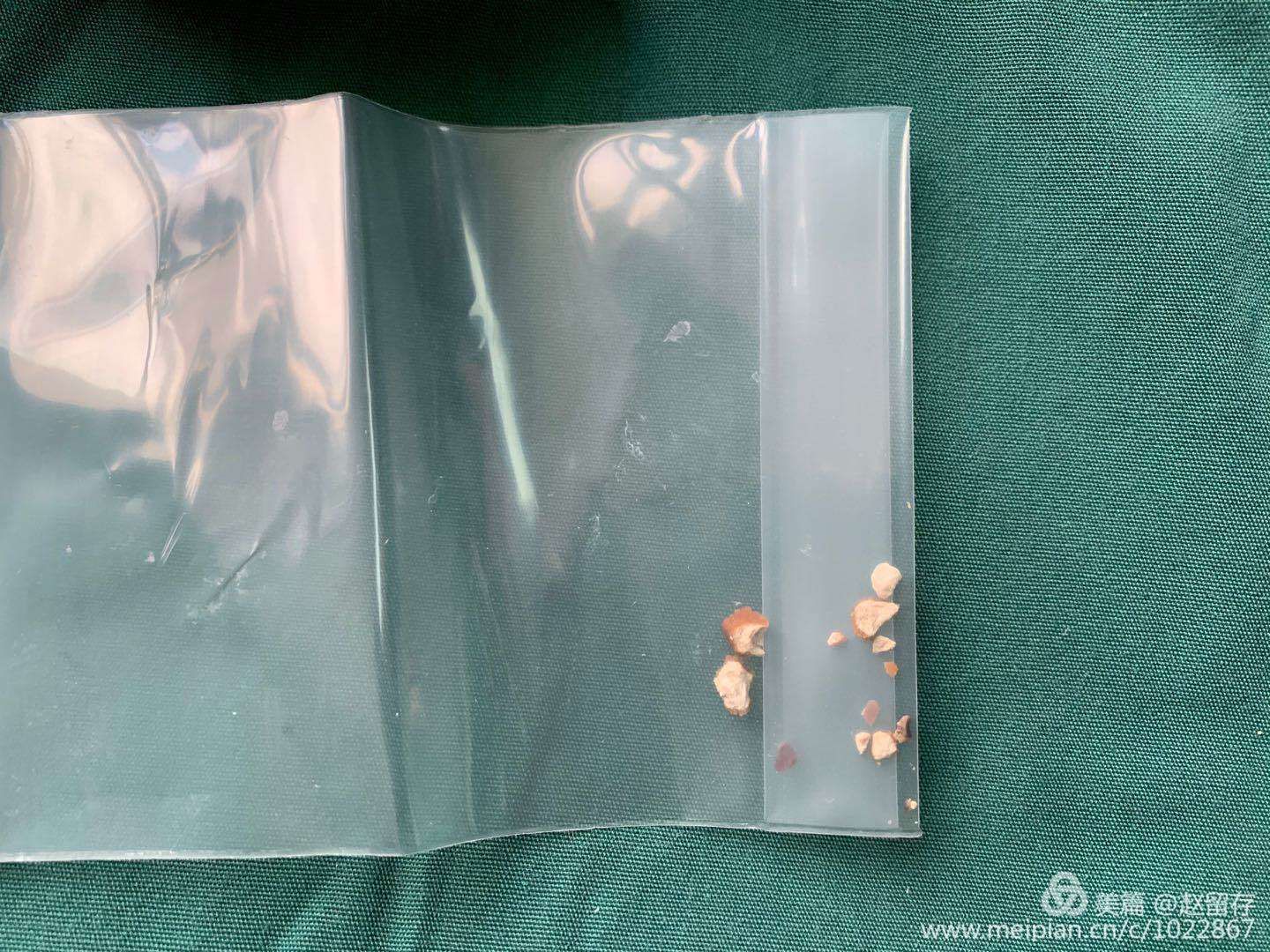 泌尿外科双镜联合治疗特殊膀胱结石