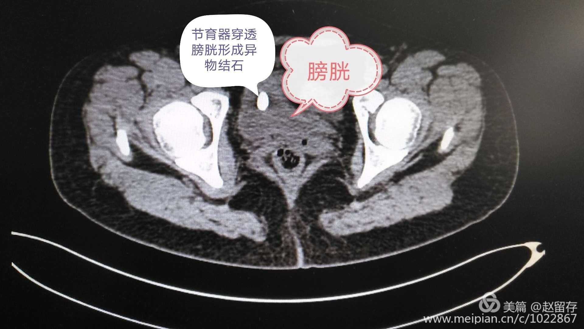 泌尿外科双镜联合治疗特殊膀胱结石