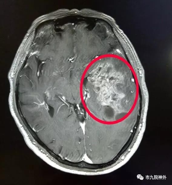 57岁颞叶占位—胶质瘤患者深受疾病困扰,市九院专家“精准狠”完成高风险手术 57岁颞叶占位—胶质瘤患者深受疾病困扰,市九院专家“精准狠”完成高风险手术