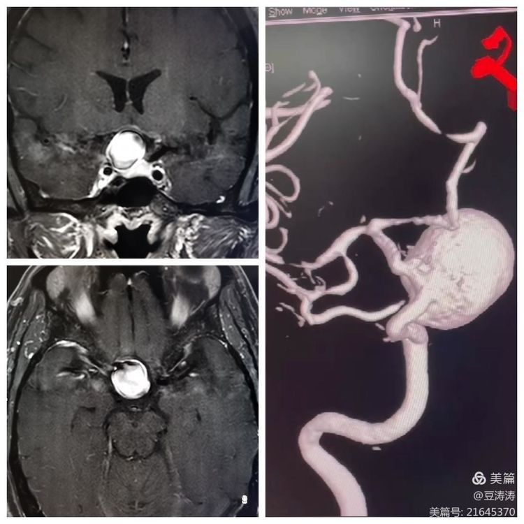 特色展示之九-血流导向装置在颅内复杂动脉瘤中的应用