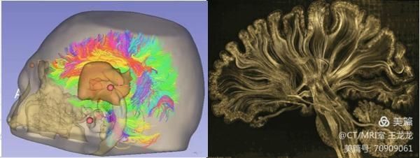 血管壁高分辨成像在头颈部血管斑块的危险性评估应用