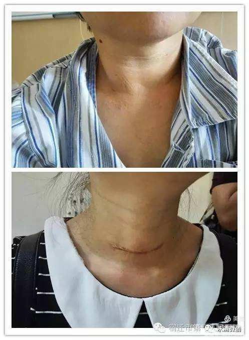 微波消融在甲状腺结节治疗的应用