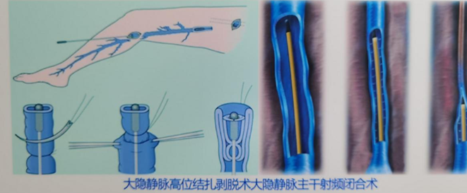 【健康科普】“蚯蚓腿”是怎样形成的? 【健康科普】“蚯蚓腿”是怎样形成的?