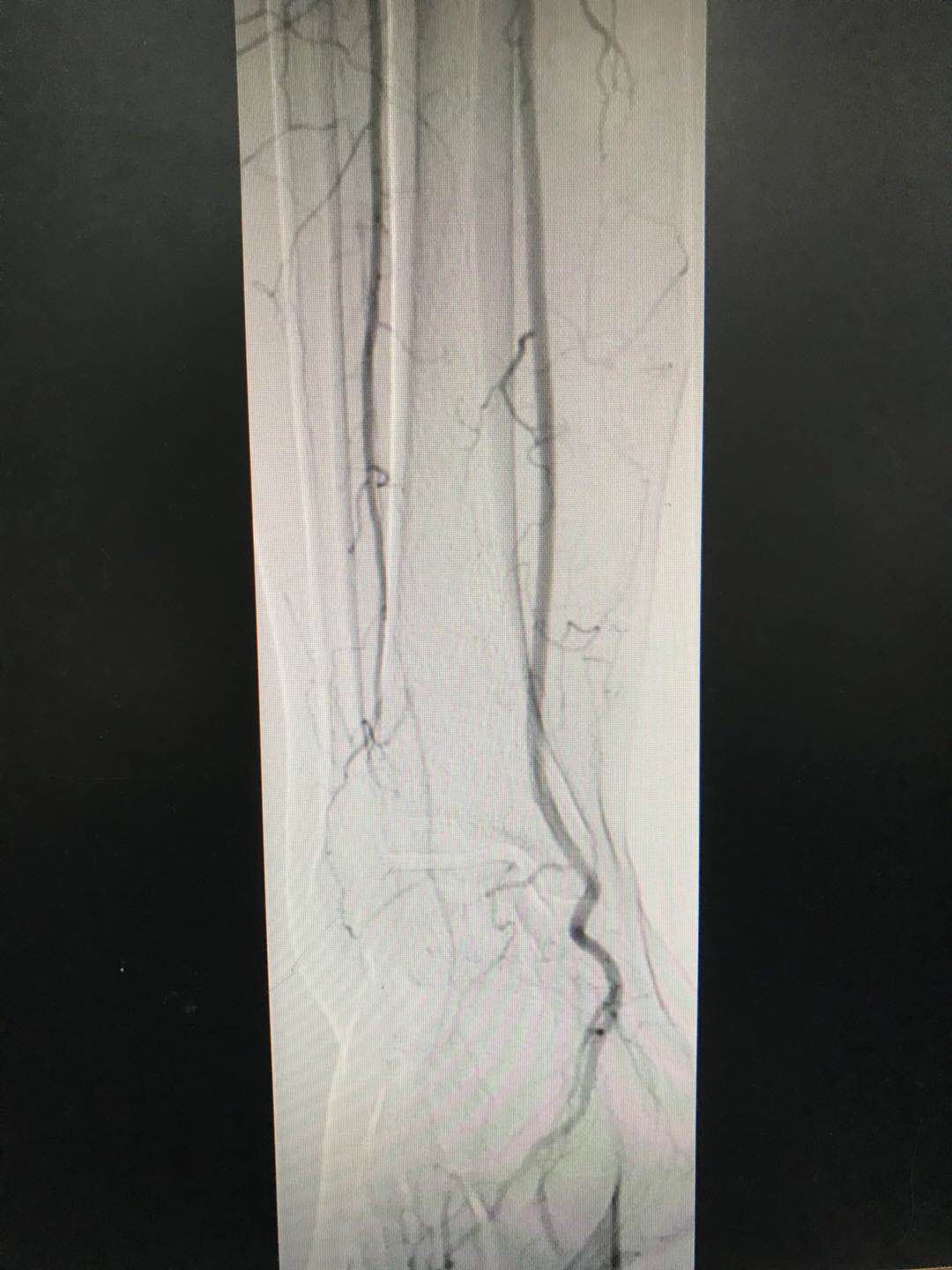 西安市第九医院内分泌科完成首例下肢动脉造影术 西安市第九医院内分泌科完成首例下肢动脉造影术