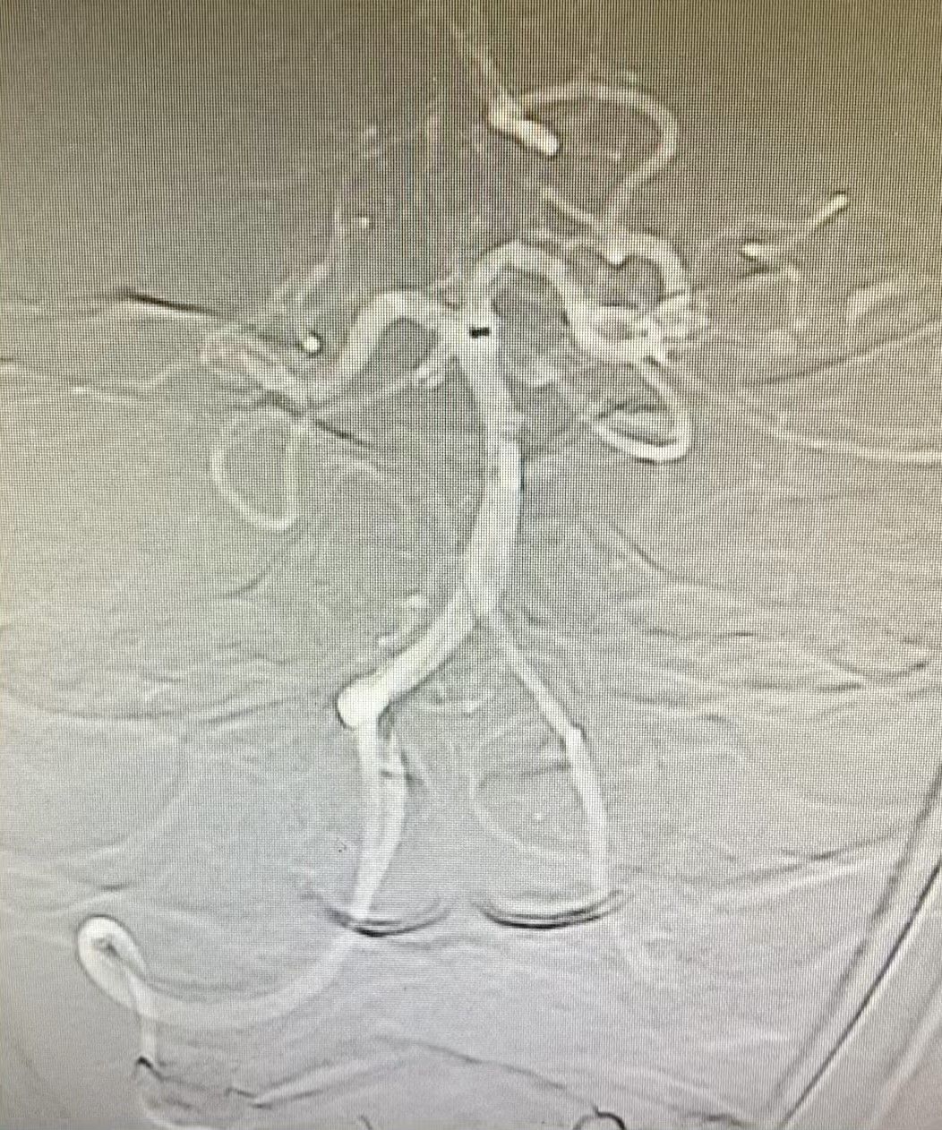 ADAPT技术快速开通颅内动脉栓塞一例 ADAPT技术快速开通颅内动脉栓塞一例