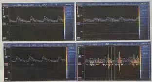 【科室动态】开通堵塞生命的河道