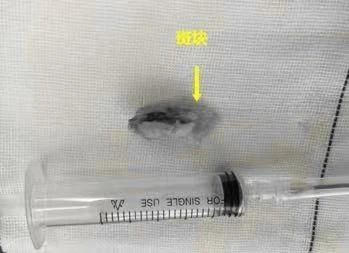 【科室动态】开通堵塞生命的河道