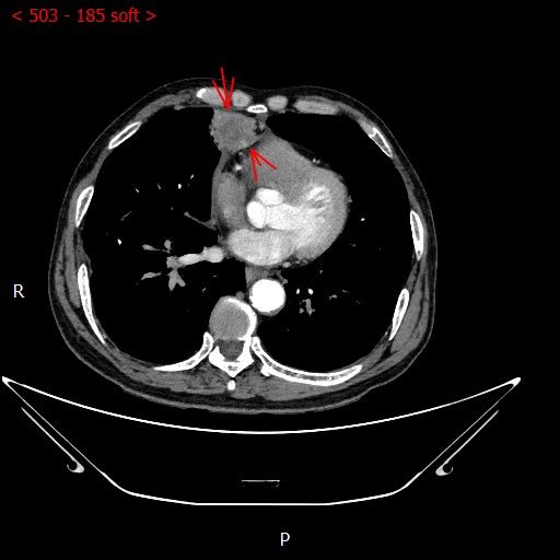 不开刀杀肿瘤：血管介入科开展首例CT引导下肺恶性肿瘤射频消融术